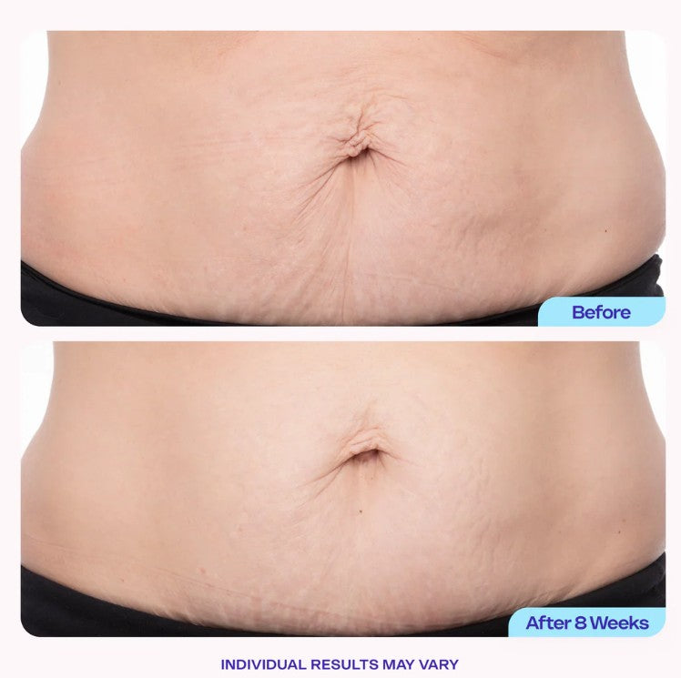 Tighten and Smooth Belly Cream